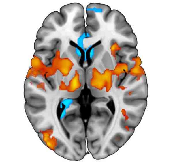 تصویربرداری عملکردی (fMRI)